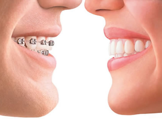 брекеты или каппы Invisalign? брекеты или каппы Invisalign?