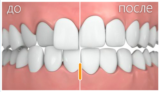 Почему Invisalign - до и после исправления прикуса Почему Invisalign - до и после исправления прикуса